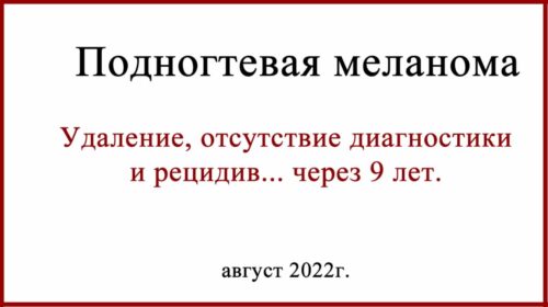 Рецидив подногтевой меланомы через 9 лет после удаления. История
