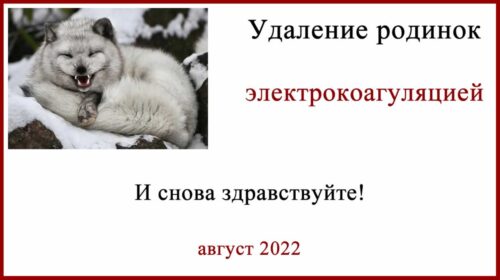 Удаление родинок электрокоагуляцией. Ошибки гистологии и меланома