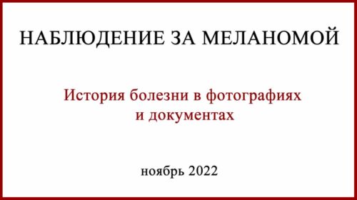 Наблюдение за меланомой
