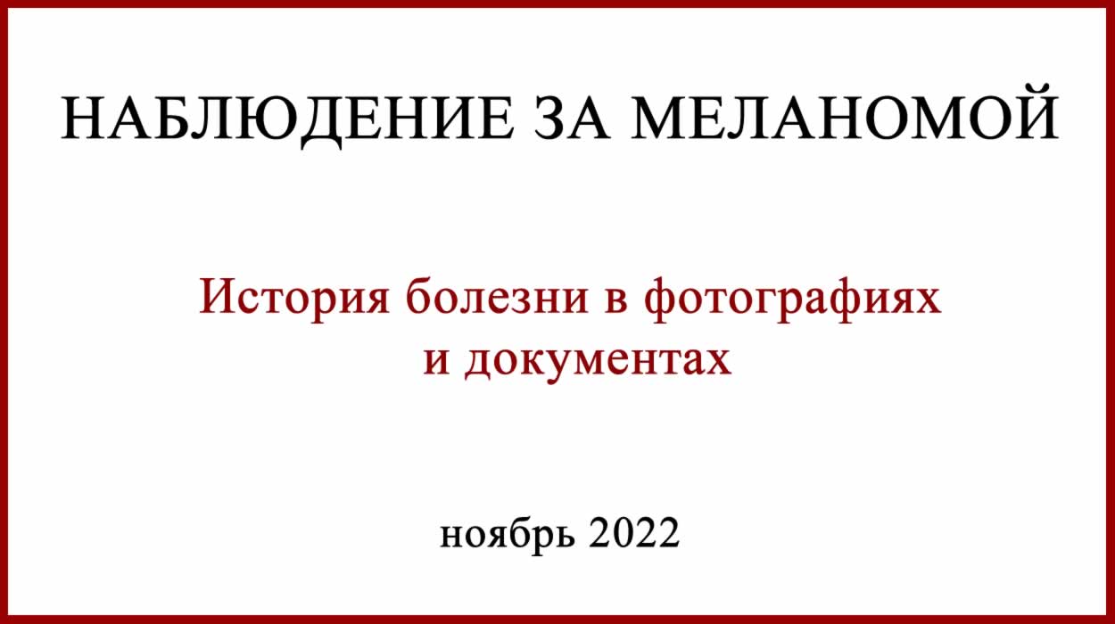 Наблюдение за меланомой. История болезни. Фото. Наблюдение за меланомой