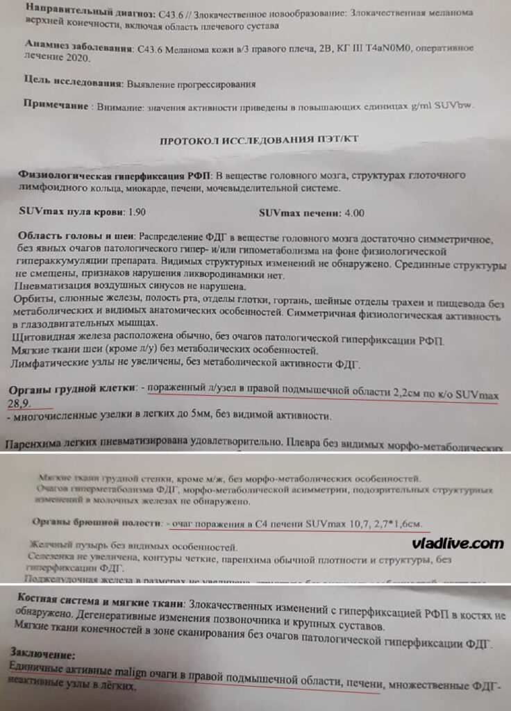 Истории про меланому. ПЭТ КТ после полной регрессии меланомы