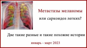 Метастазы меланомы или саркоидоз легких. Зачем нужна биопсия. Две истории