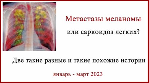 Метастазы меланомы или саркоидоз легких. Зачем нужна биопсия. Две истории