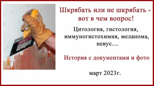 О том, как меланома превратилась в диспластический невус.
