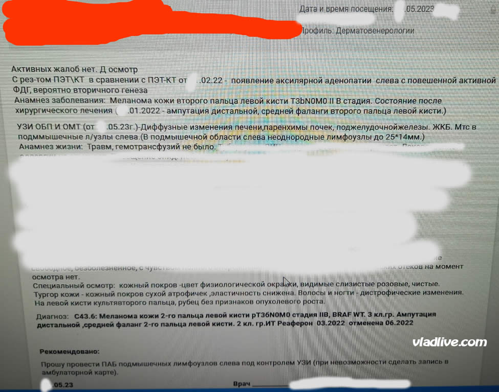 Ампутация пальца при меланоме. ИТОГ