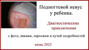 Подногтевой невус у ребенка. История диагностики