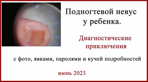 Подногтевой невус у ребенка. История диагностики