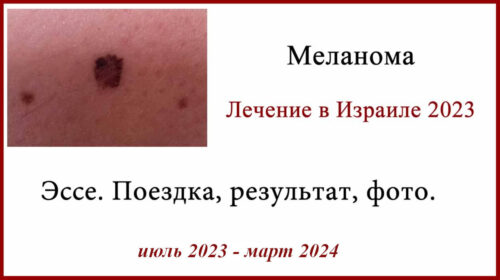 Отзыв о лечении в Израиле в 2023. Поездка, фото, результат и психологические проблемы после лечения