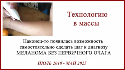 Ручка для удаления родинок или здравствуй, меланома без первичного очага.