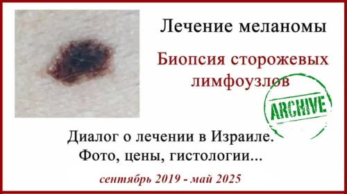 Меланома 2,1 мм. Биопсия сторожевых лимфоузлов в Израиле. Отзыв о поездке. 2019-2025 годы.