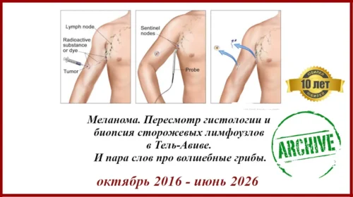 Меланома 2.2 мм. Кларк IV, 3 митоза. БСЛУ - Биопсия сторожевых лимфоузлов в Израиле. 2016 - 2026