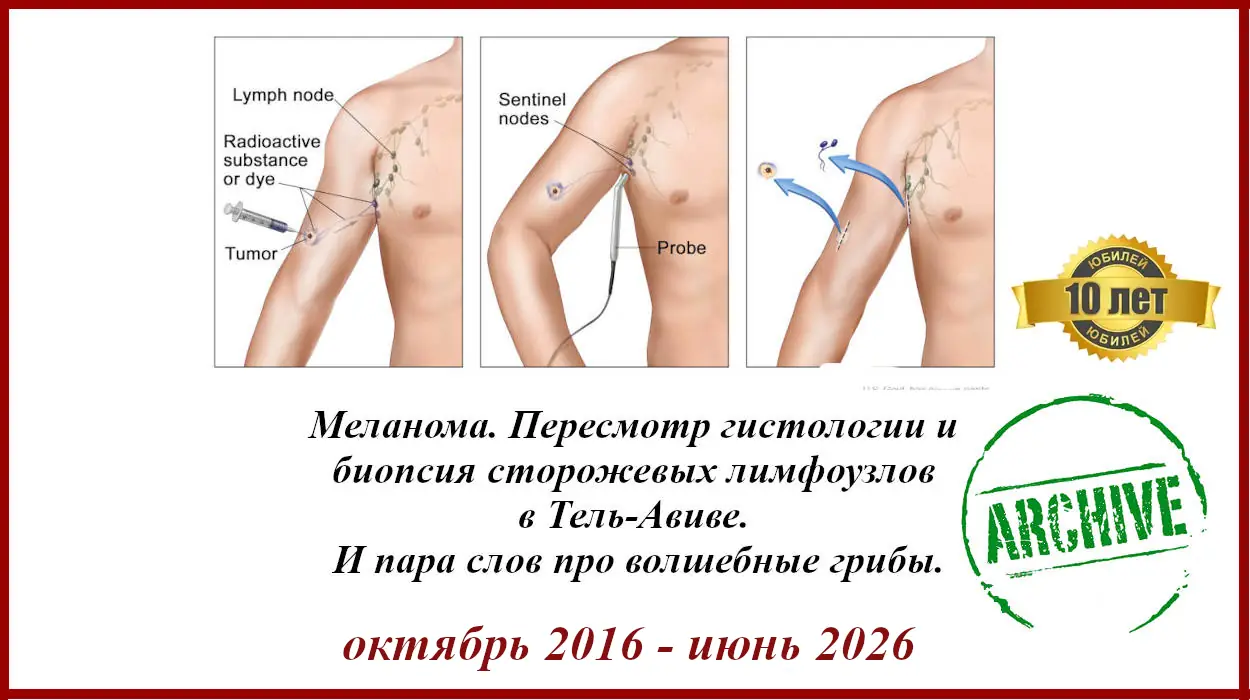 Лечение в Израиле. Меланома 2.2 мм. Меланома 2.2 мм. Кларк IV, 3 митоза. БСЛУ - Биопсия сторожевых лимфоузлов в Израиле. 2016 - 2026