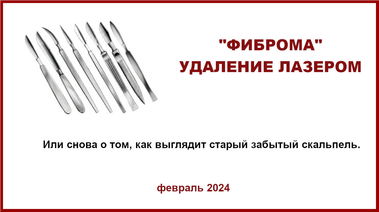 Фиброма. Гистология после удаления лазером.