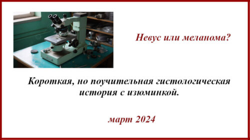 Невус или меланома?