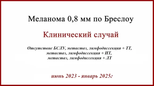 Меланома 0.8 мм по Бреслоу. Отсутствие БСЛУ, лимфодиссекция, таргетная и иммунотерапия, облучение. Клинический случай