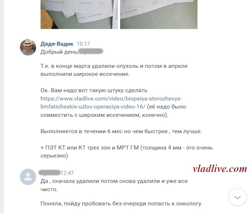 Меланома 4 мм.