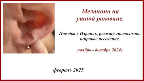 Меланома кожи ушной раковины. Отзыв о поездке в Израиль