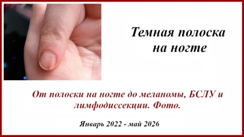 Темная полоска на ногте. От грибка, до акрального невуса и меланомы. БСЛУ, лимфодисскция и т.д.