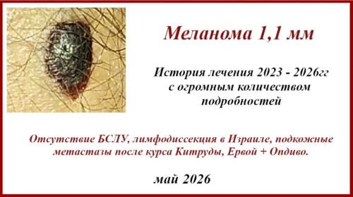 Лимфодиссекция в Израиле 2023г. Меланома 1,1 мм. Фото. Метастазы в л/у, лимфодиссекция в Израиле, подкожные mts, Ервой +Опдиво.