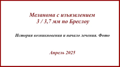 Меланома с изъязвлением, 3 / 3,7 по Бреслоу. БСЛУ, адъювантная терапия. Арфлейда