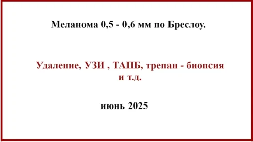 Меланома 0.6 мм (0.5 мм). История лечения