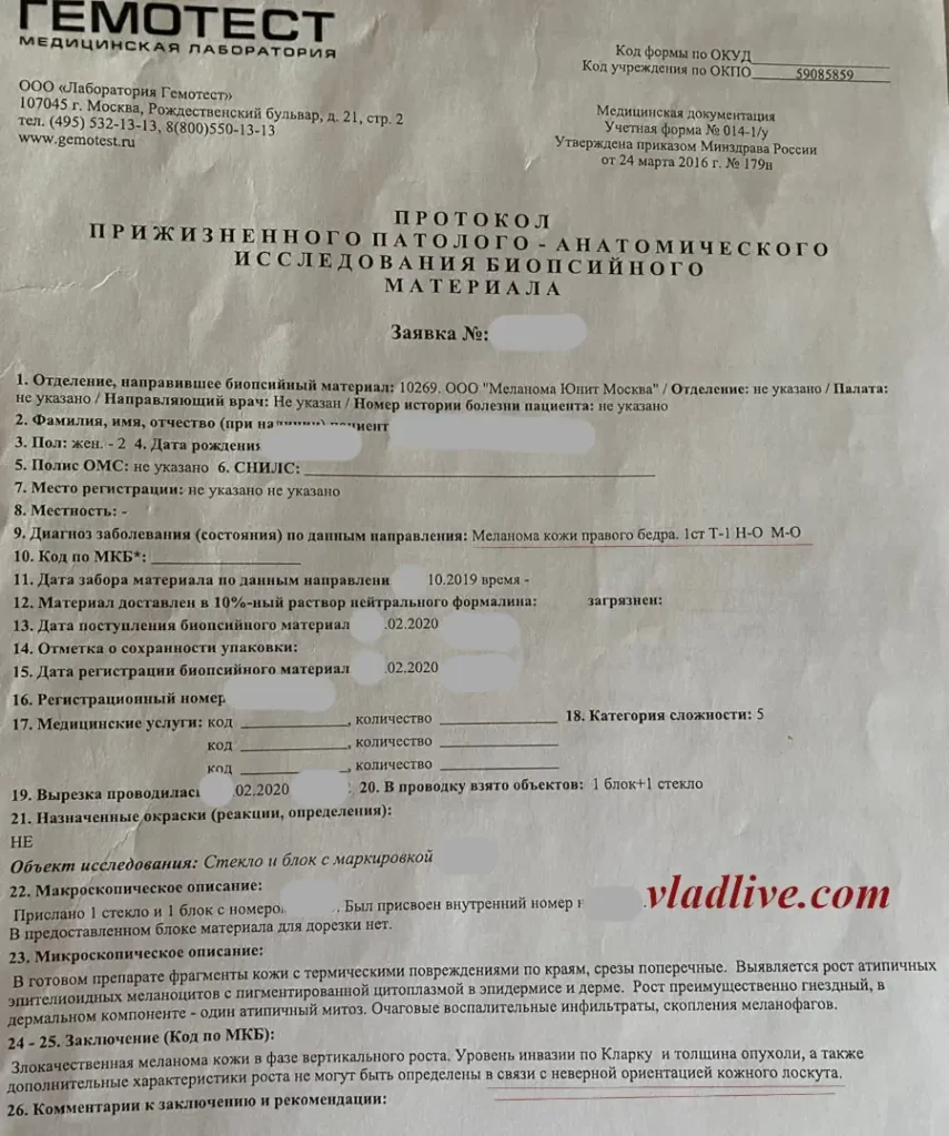 Меланома на бедре. Ревизия гистологии. Неверная ориентация кожного лоскута