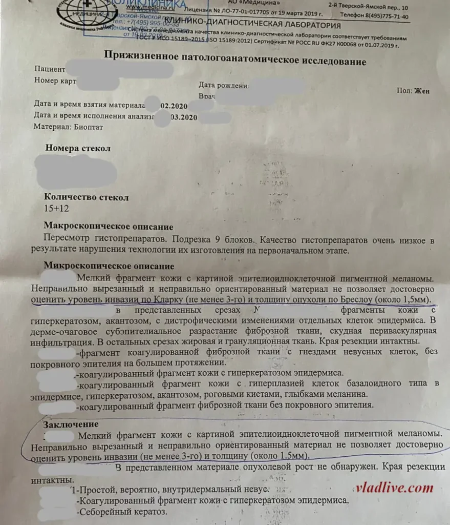 Гистология меланомы. Неправильно вырезанный материал.