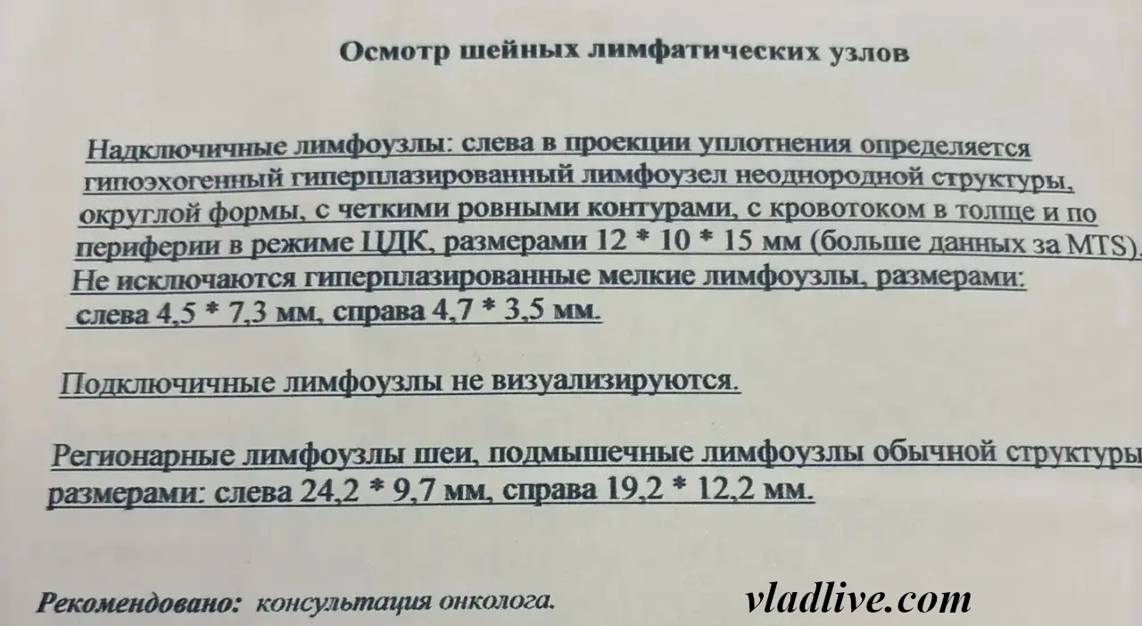 Меланома на спине. УЗИ. Увеличенный надключичный лимфоузел