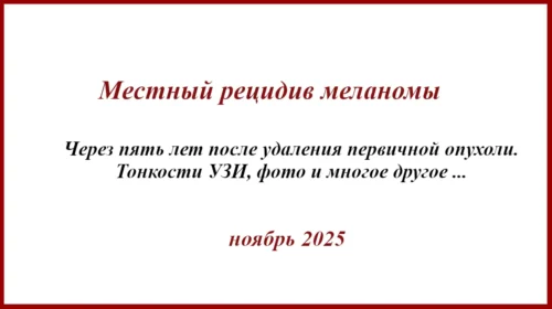 Местный рецидив меланомы. История лечения
