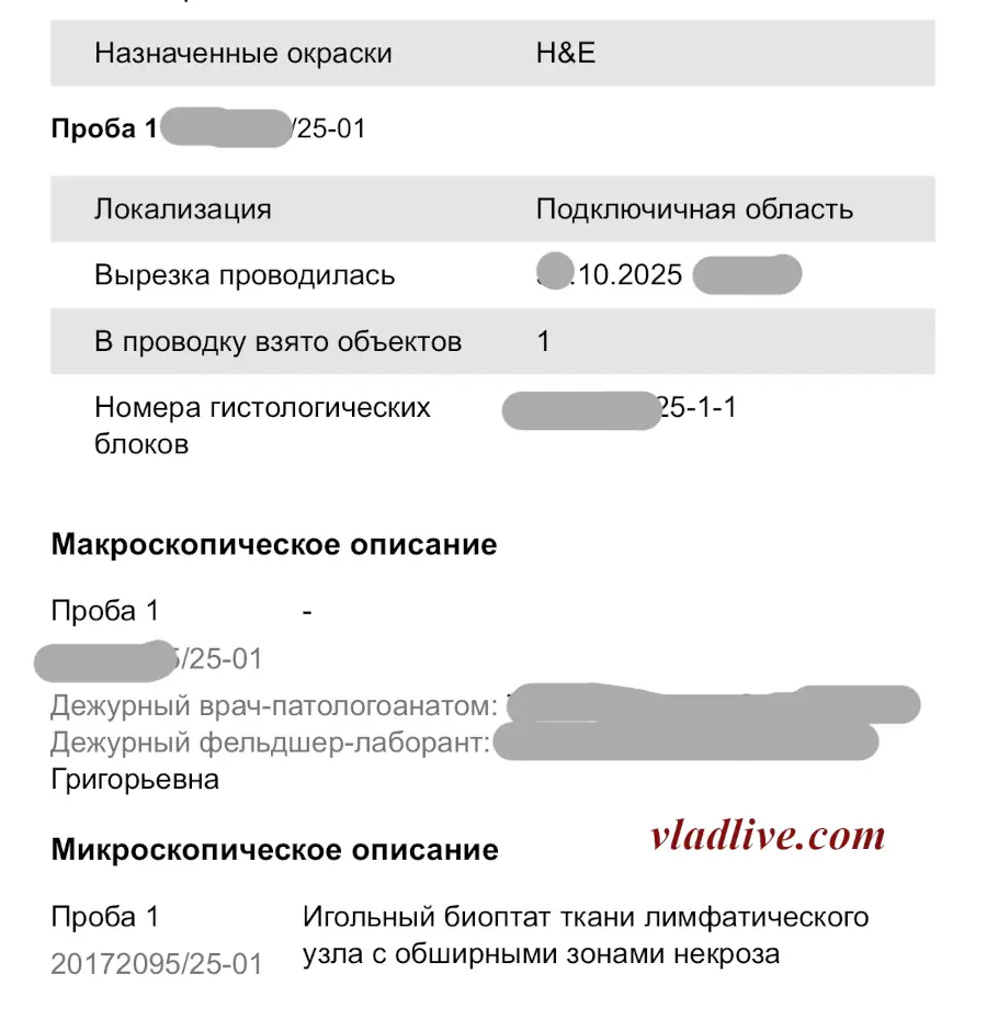 Core-биопсия лимфоузла. TRU CUT