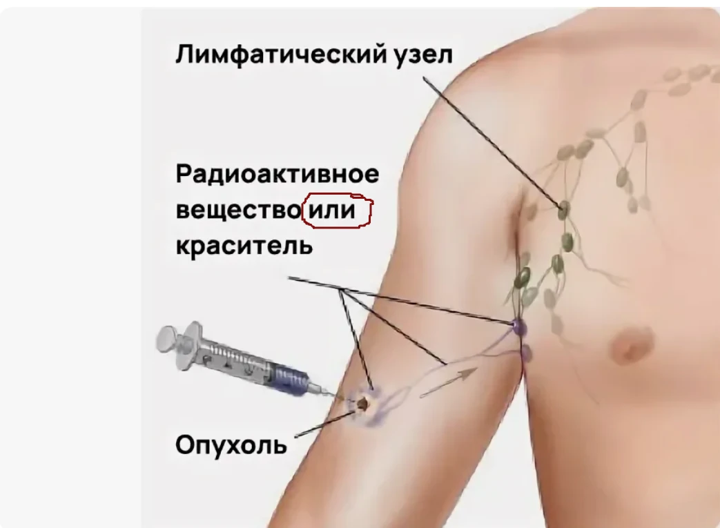 Выполнение биопсии сторожевых лимфоузлов (БСЛУ) в РФ