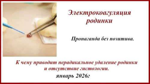 Электрокоагуляция родинки