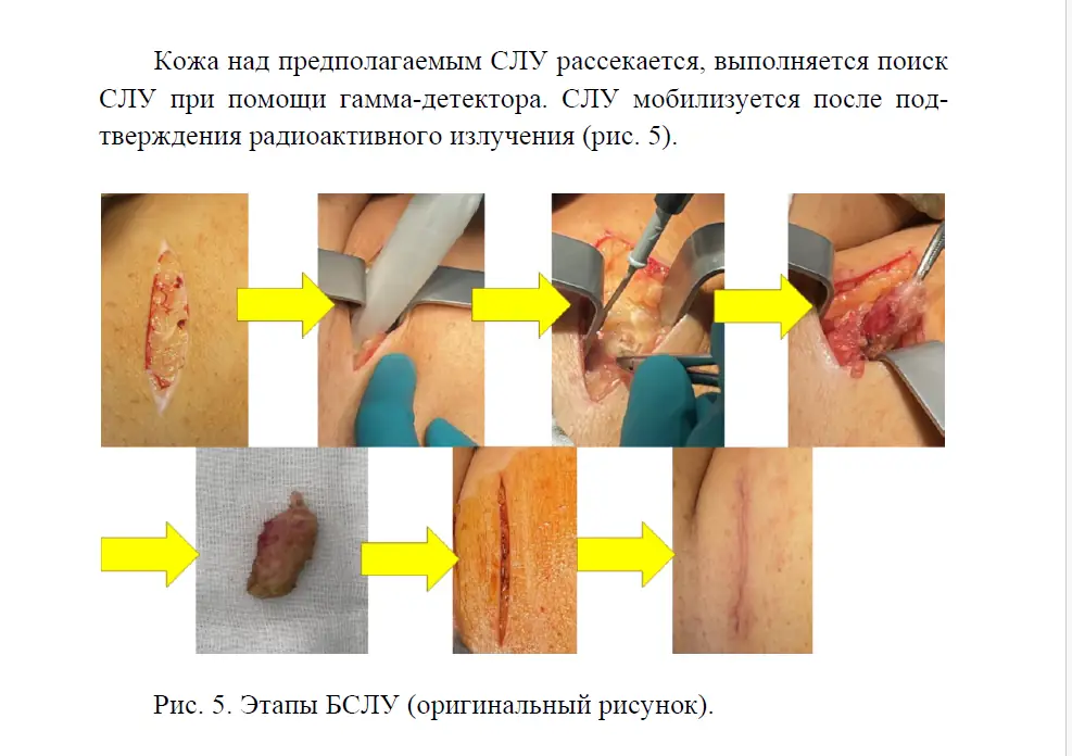 Биопсия сторожевого лимфоузла. Этапы выполнения БСЛУ в РФ