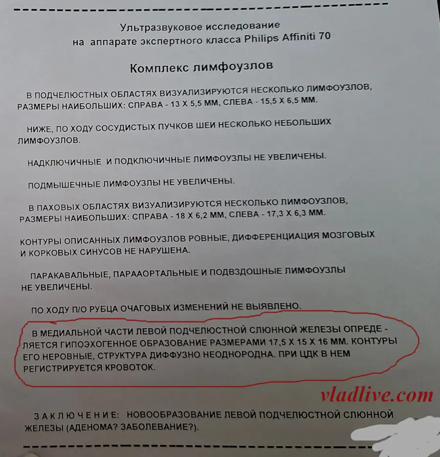 УЗИ. Метастаз в подчелюстном лимфоузле