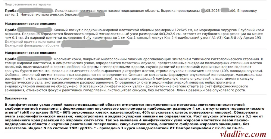 Меланома 1 мм, метастазы в лимфоузлах