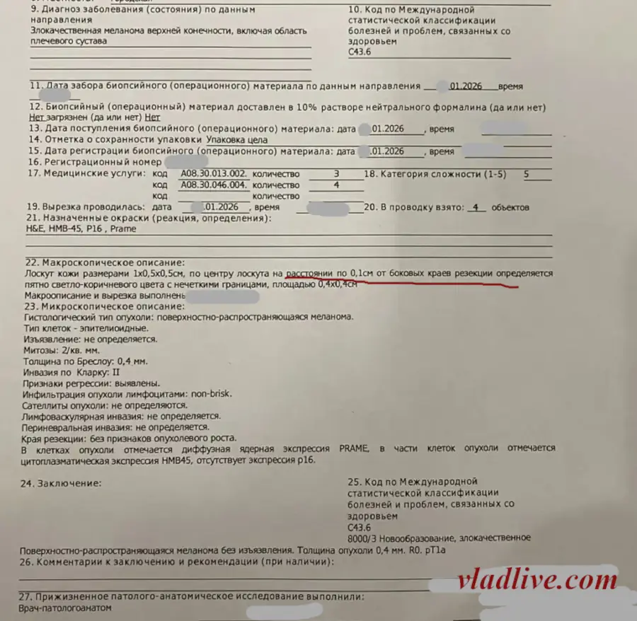 Гистология. Меланома 0,4 мм. Стадия 1А