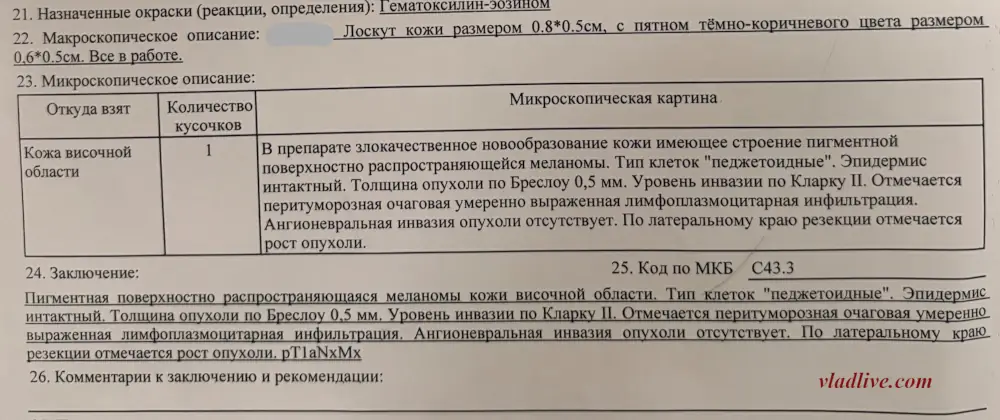 Меланома височной области. Гистология