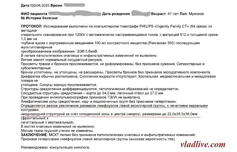Меланома менее 1 мм по Бреслоу. УЗИ.