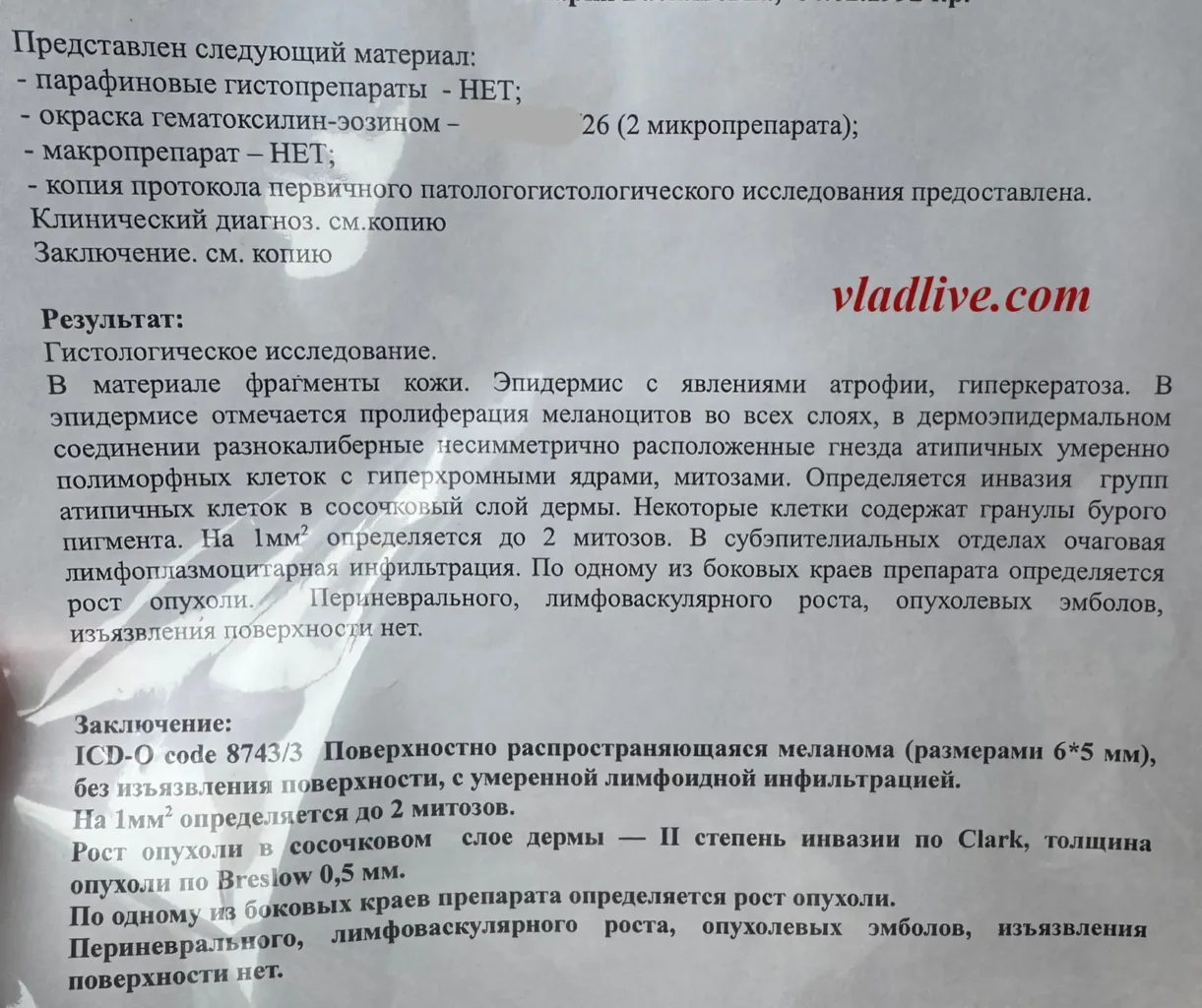 Меланома на виске. Ревизия гистологии