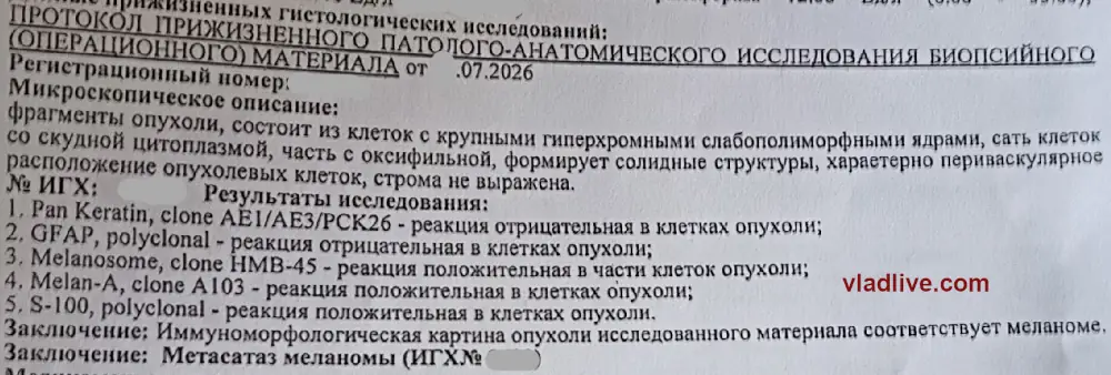 Метастаз меланомы в головной мозг