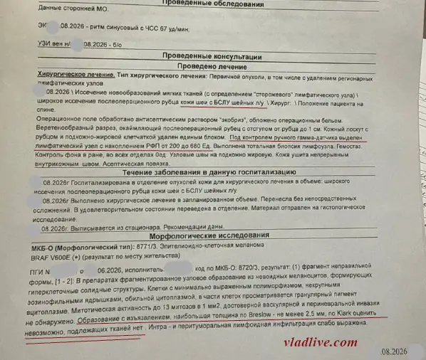 Удаление родинки лазером, меланома IIB, БСЛУ